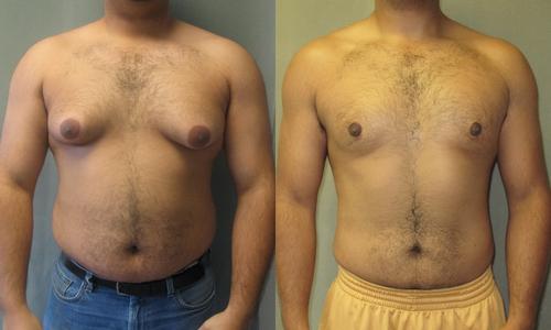 Tips for Healing Gynecomastia